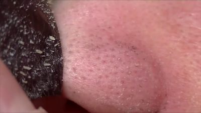 ideas innovadoras: saca espinillas